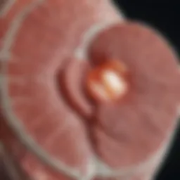 A detailed diagram illustrating the anatomy of a discus hernia