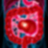 Adenocarcinoma in Gastrointestinal Tract Illustration of adenocarcinoma in the gastrointestinal tract