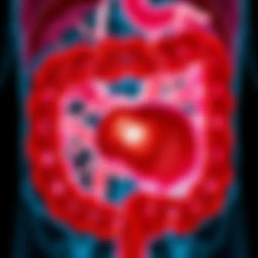 Adenocarcinoma in Gastrointestinal Tract Illustration of adenocarcinoma in the gastrointestinal tract